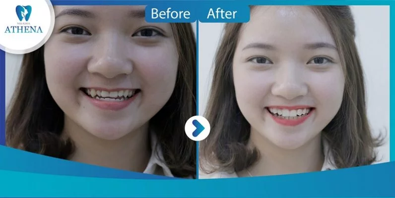 nieng_rang_trong_suot