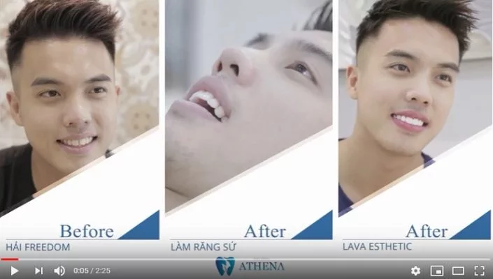 lam_răng_su_tham_my