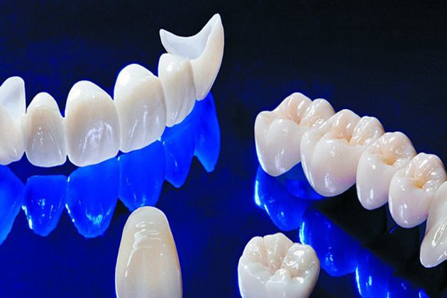 Bọc răng sứ tại Phương Canh loại nào là tốt nhất?