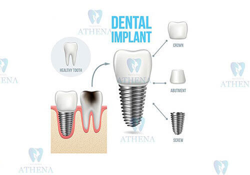 cấy ghép răng Implant