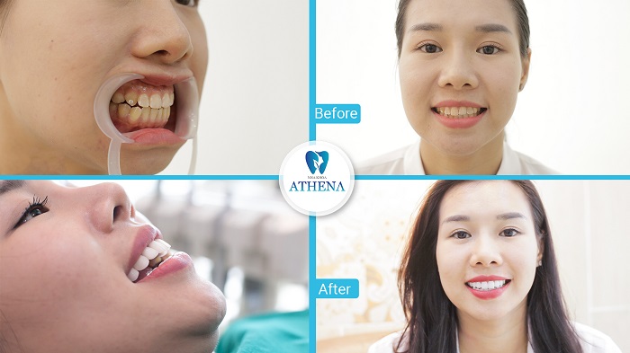 Bọc răng sứ veneer tại Hà Nội có tốt không?