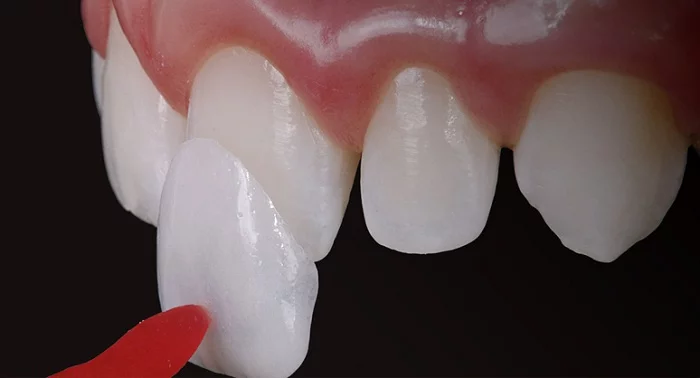 Răng sứ Veneer bảo hành bao lâu tại nha khoa ở Nghĩa Tân?