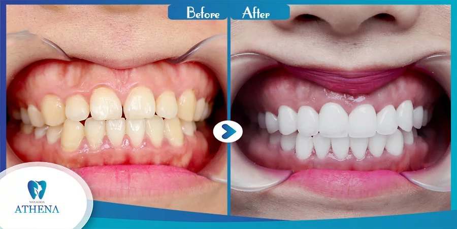 Răng sứ Veneer có tốt không rang_su_phong_thuy