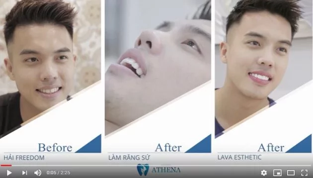 Tấy trắng răng tại Đại Mỗ không đau bằng đèn Plasma Tấy trắng răng tại Đại Mỗ không đau bằng đèn Plasma