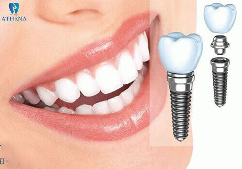 cắm ghép răng Implant