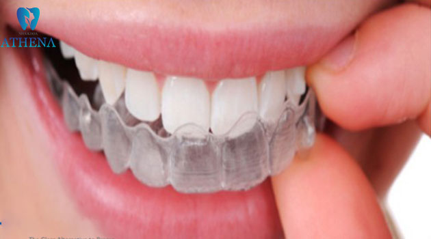 chỉnh nha trong suốt Invisalign (2)