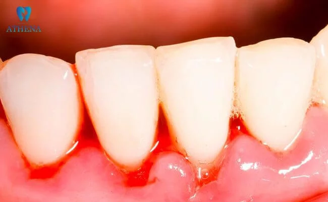 chay_mau_chan_rang_2