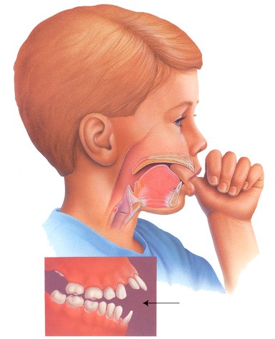 Mút tay dẫn đến tình trạng răng bị lệch lạc