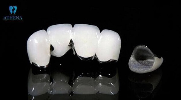 Răng sứ kim loại 