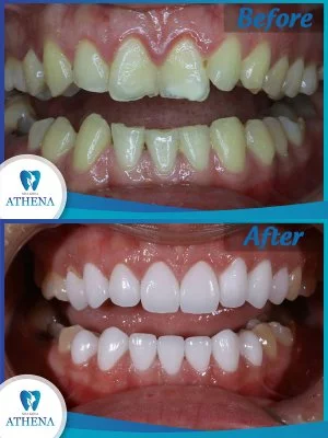 boc_rang_su_phong_thuy