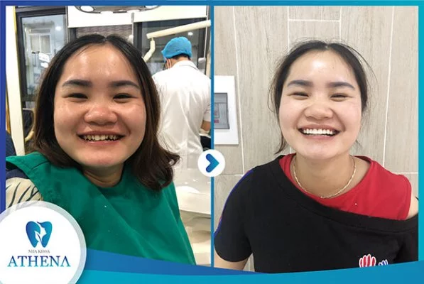 boc_rang_su_phong_thuy