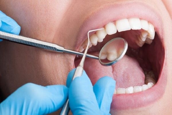Trước khi thực hiện lấy cao răng cần kiểm tra tình trạng răng miệng