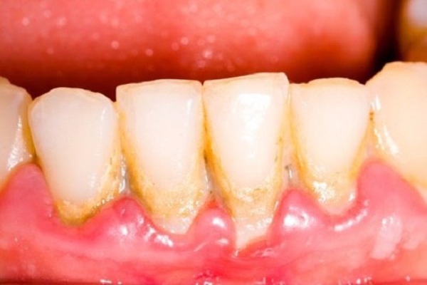Cao răng là những mảng bám màu vàng