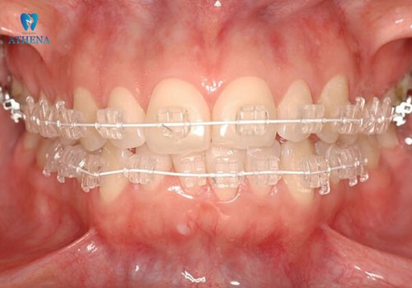 Niềng răng pha lê có nhiều điểm tương đồng với niềng răng mắc cài sứ