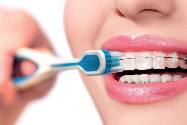 Vệ sinh răng miệng sạch sẽ bằng cách loại bàn chải cho người niềng răng