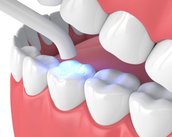 Hàn răng sâu giá bao nhiêu tiền, có cao không?