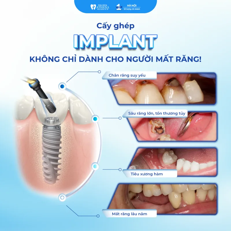 Tác Hại Của Trồng Răng Khi Chọn Địa Chỉ Không Uy Tín: Những Nguy Cơ Bạn Không Nên Bỏ Qua