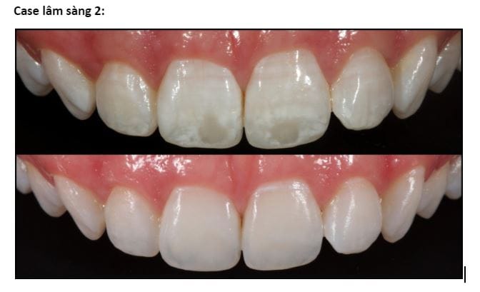 ĐỐM TRẮNG TRÊN RĂNG SAU KHI NIỀNG LÀ GÌ? NGUYÊN NHÂN, CẤP ĐỘ VÀ CÁCH XỬ LÝ HIỆU QUẢ