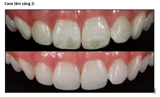 ĐỐM TRẮNG TRÊN RĂNG SAU KHI NIỀNG LÀ GÌ? NGUYÊN NHÂN, CẤP ĐỘ VÀ CÁCH XỬ LÝ HIỆU QUẢ