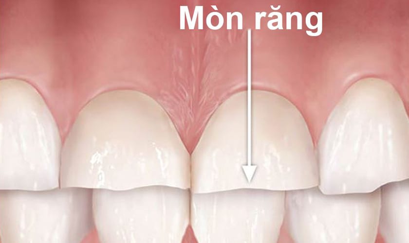 Mòn Răng là gì? Nguyên nhân, Dấu hiệu và 5 Cách Điều Trị Hiệu Quả Nhất