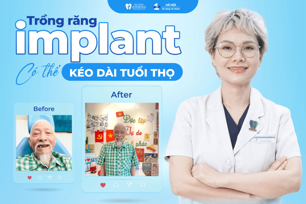 TRỒNG RĂNG IMPLANT CÓ THỂ KÉO DÀI TUỔI THỌ – VÌ SAO LẠI NHƯ VẬY?