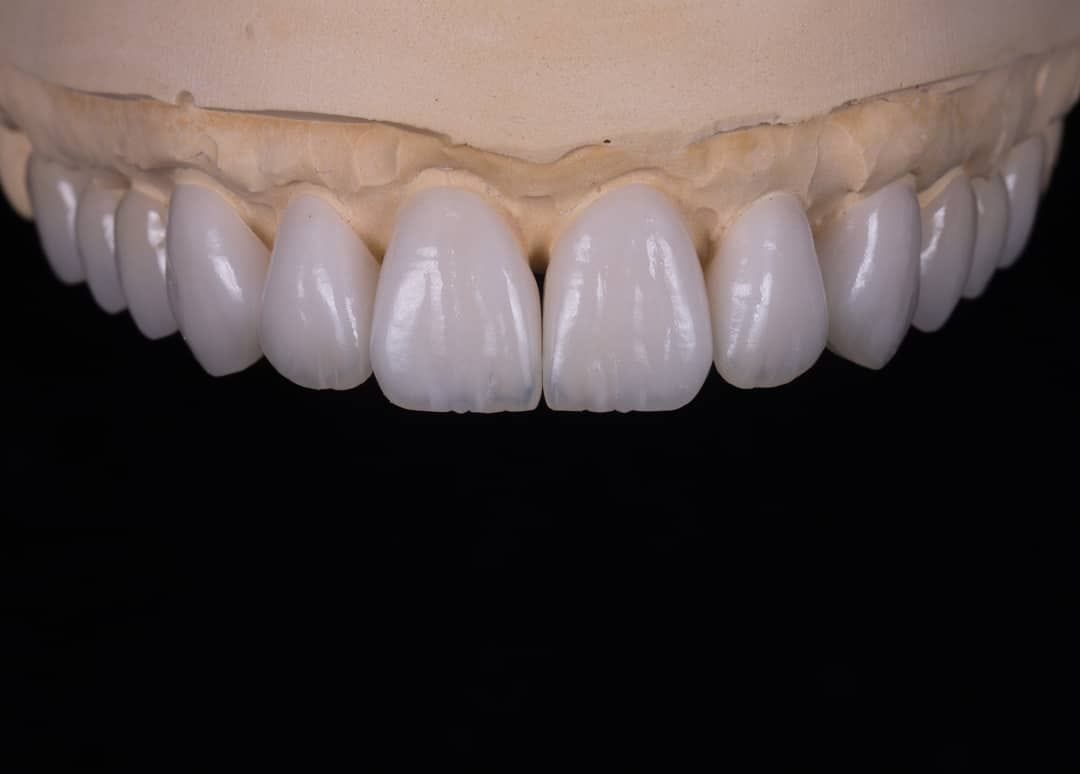 BÍ QUYẾT CHỌN DÁNG RĂNG SỨ PHÙ HỢP VỚI GƯƠNG MẶT