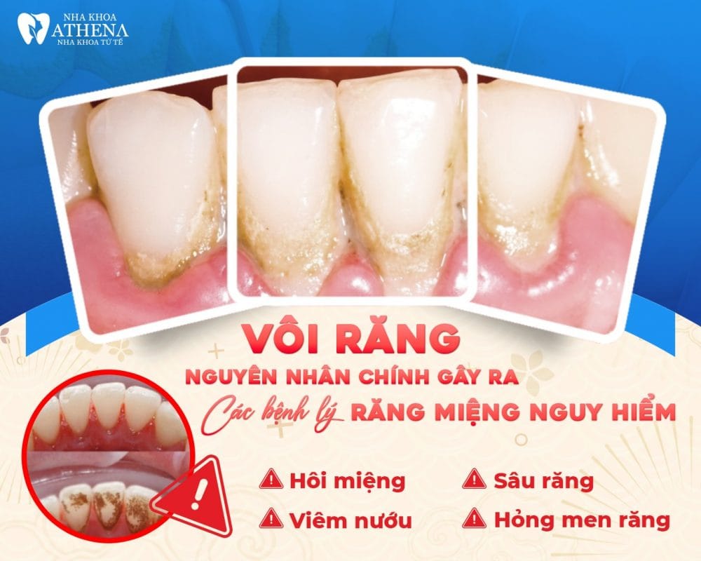 Vôi răng là gì? Nguyên nhân gây ra các bệnh lý răng miệng nguy hiểm
