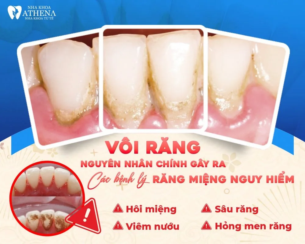 Vôi răng là gì? Nguyên nhân gây ra các bệnh lý răng miệng nguy hiểm