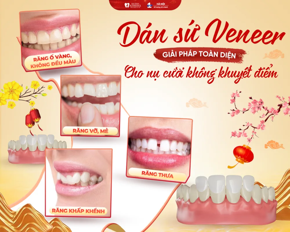 Dán sứ Veneer - Giải pháp toàn diện cho nụ cười không khuyết điểm