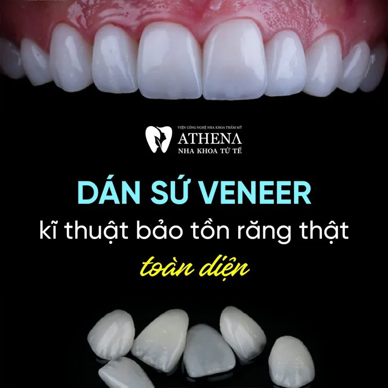 Dán sứ Veneer - Giải pháp toàn diện cho nụ cười không khuyết điểm