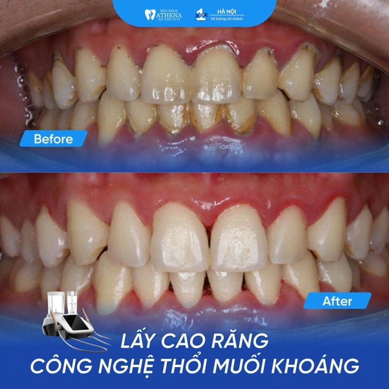 LÀM SẠCH RĂNG CHUYÊN SÂU BẰNG THỔI MUỐI KHOÁNG: QUY TRÌNH VÀ ƯU ĐIỂM VƯỢT TRỘI
